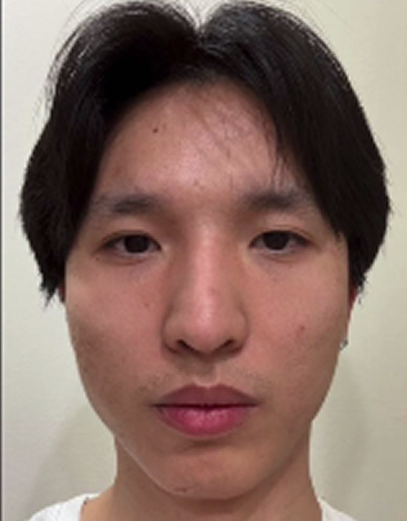 Marco Mei before treatment