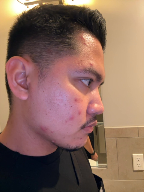 Jamery before treatment