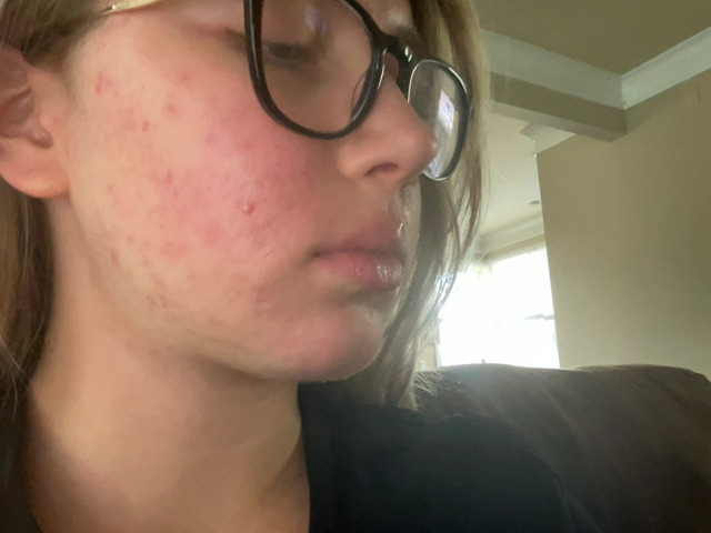 Emma after treatment