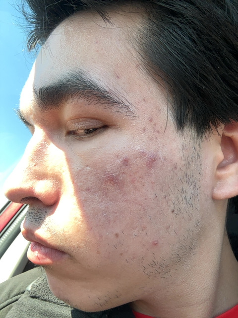 Adam Garcia before treatment