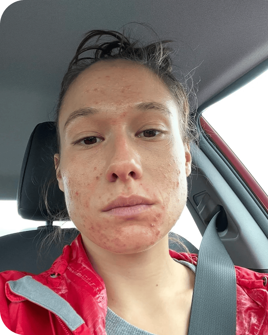 Brooke before treatment