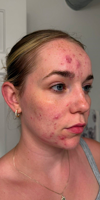 Caitlin before treatment